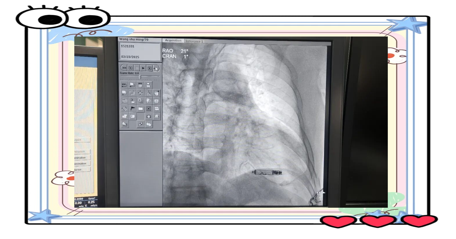 不用换电池的无导线心脏起搏器研发成功