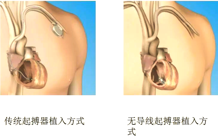 不用换电池的无导线心脏起搏器研发成功
